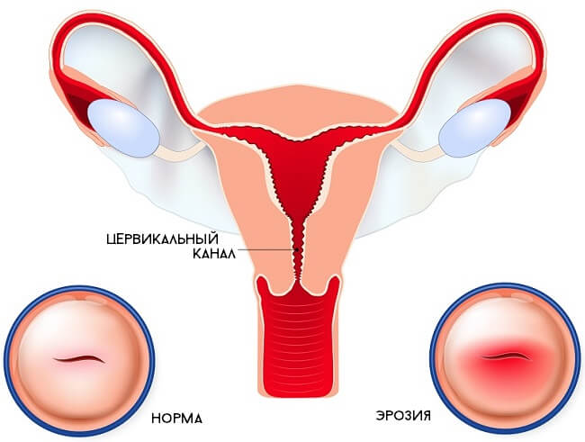 Эрозия что это. Эрозия матка шейки матки.